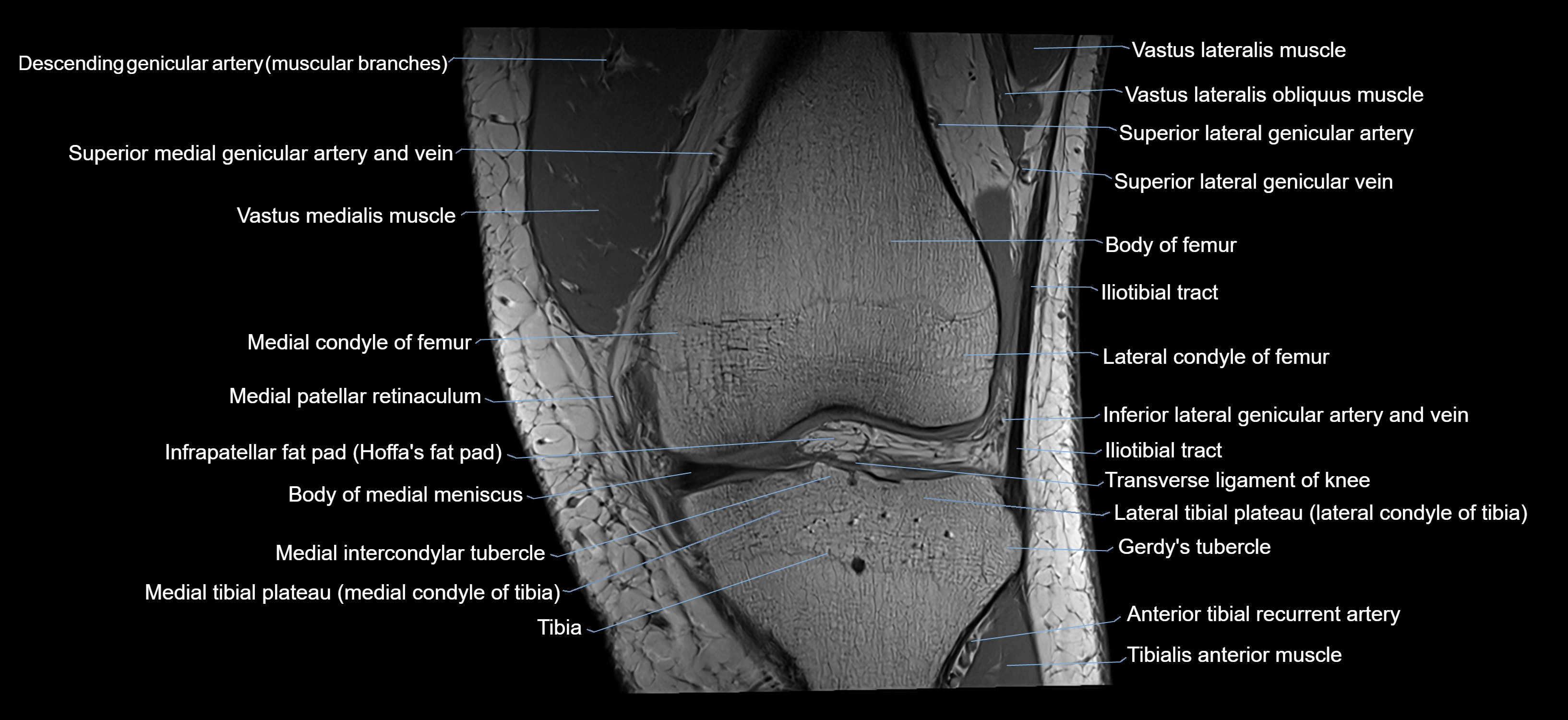 MRI knee coronal cross sectional anatomy labelled 3T radiology  image-04001-00015.webp
